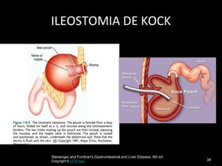 38
ILEOSTOMIA DE KOCK
Sleisenger and Fordtran's Gastrointestinal and Liver Disease, 9th ed.
Copyright © 2010 Sau
 