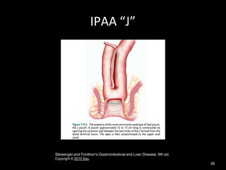 IPAA “J”
Sleisenger and Fordtran's Gastrointestinal and Liver Disease, 9th ed.
Copyright © 2010 Sau
39
 