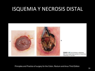ISQUEMIA Y NECROSIS DISTAL
Principles and Practice of surgery for the Colon, Rectum and Anus Third Edition
50
 
