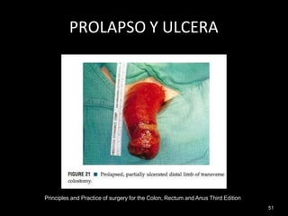 PROLAPSO Y ULCERA
Principles and Practice of surgery for the Colon, Rectum and Anus Third Edition
51
 