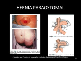 HERNIA PARAOSTOMAL
Principles and Practice of surgery for the Colon, Rectum and Anus Third Edition
52
 