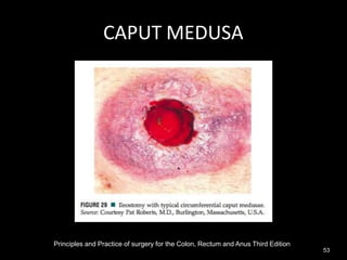 CAPUT MEDUSA
Principles and Practice of surgery for the Colon, Rectum and Anus Third Edition
53
 