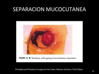 SEPARACION MUCOCUTANEA
Principles and Practice of surgery for the Colon, Rectum and Anus Third Edition
54
 