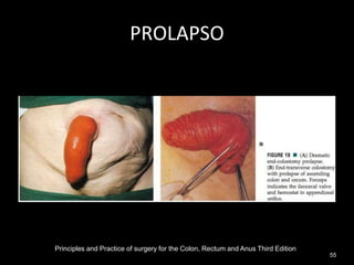 PROLAPSO
Principles and Practice of surgery for the Colon, Rectum and Anus Third Edition
55
 
