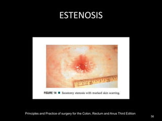 ESTENOSIS
Principles and Practice of surgery for the Colon, Rectum and Anus Third Edition
56
 