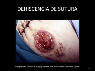 DEHISCENCIA DE SUTURA
Principles and Practice of surgery for the Colon, Rectum and Anus Third Edition
57
 