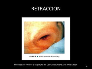 RETRACCION
Principles and Practice of surgery for the Colon, Rectum and Anus Third Edition
58
 