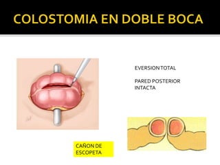 EVERSIONTOTAL
PARED POSTERIOR
INTACTA
CAÑON DE
ESCOPETA
 