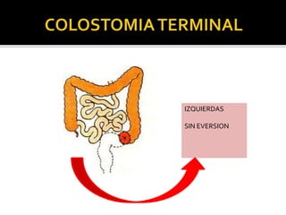 IZQUIERDAS
SIN EVERSION
 