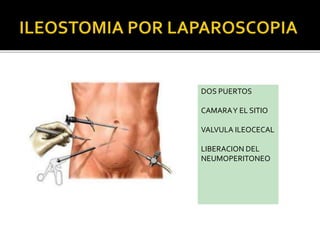 DOS PUERTOS
CAMARAY EL SITIO
VALVULA ILEOCECAL
LIBERACION DEL
NEUMOPERITONEO
 