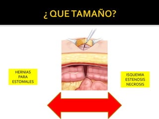 HERNIAS
PARA
ESTOMALES
ISQUEMIA
ESTENOSIS
NECROSIS
 
