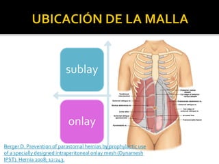 sublay
onlay
Berger D. Prevention of parastomal hernias by prophylactic use
of a specially designed intraperitoneal onlay mesh (Dynamesh
IPST). Hernia 2008; 12:243.
 