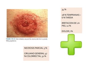 34 %
28 %TEMPRANAS –
6 %TARDIA
IRRITACION DE LA
PIEL 12 %
DOLOR 7 %
NECROSIS PARCIAL 5 %
CIRUJANO GENERAL 47
% COLORRECTAL 32 %
 