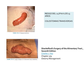 RIESGO DEL 11,8 % A LOS 13
AÑOS
COLOSTOMIASTRANSVERSAS
Shackelford's Surgery of the AlimentaryTract ,
Seventh Edition
Charles J.Yeo
Chapter 179
Ostomy Management
 