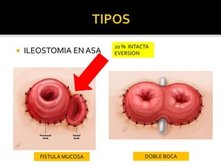  ILEOSTOMIA EN ASA
20 % INTACTA
EVERSION
FISTULA MUCOSA DOBLE BOCA
 