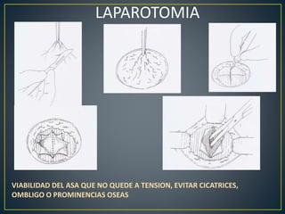 LAPAROTOMIA
VIABILIDAD DEL ASA QUE NO QUEDE A TENSION, EVITAR CICATRICES,
OMBLIGO O PROMINENCIAS OSEAS
 
