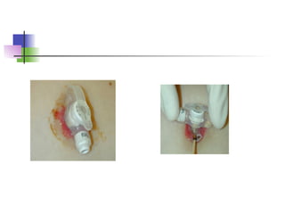 Comprehensive Guide to Medical Tubes: Types, Care, and Procedures | PPT