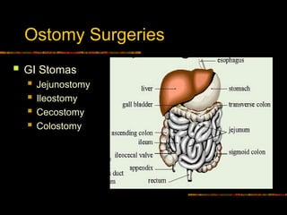 Ostomy Surgeries
 GI Stomas
 Jejunostomy
 Ileostomy
 Cecostomy
 Colostomy
 