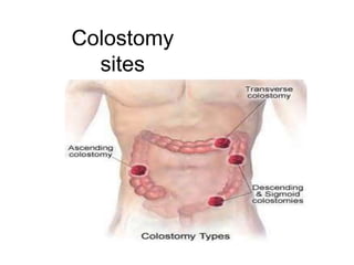 ostomy-care.pptx