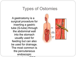 Types of Ostomies 
A gastrostomy is a 
surgical procedure for 
inserting a gastric 
tube (G-tube) through 
the abdominal wall 
into the stomach 
usually used for 
feeding but can also 
be used for drainage. 
The most common is 
the percutaneous 
endoscopic 
gastrostomy (PEG 
 
