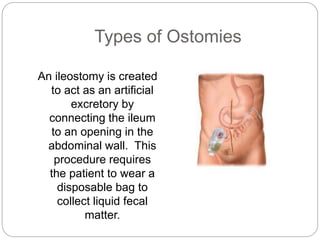 Types of Ostomies 
An ileostomy is created 
to act as an artificial 
excretory by 
connecting the ileum 
to an opening in the 
abdominal wall. This 
procedure requires 
the patient to wear a 
disposable bag to 
collect liquid fecal 
matter. 
 