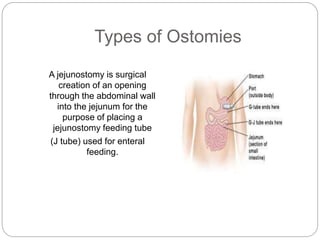 Types of Ostomies 
A jejunostomy is surgical 
creation of an opening 
through the abdominal wall 
into the jejunum for the 
purpose of placing a 
jejunostomy feeding tube 
(J tube) used for enteral 
feeding. 
 