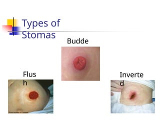 Ostomy Care power point presentation.pptx