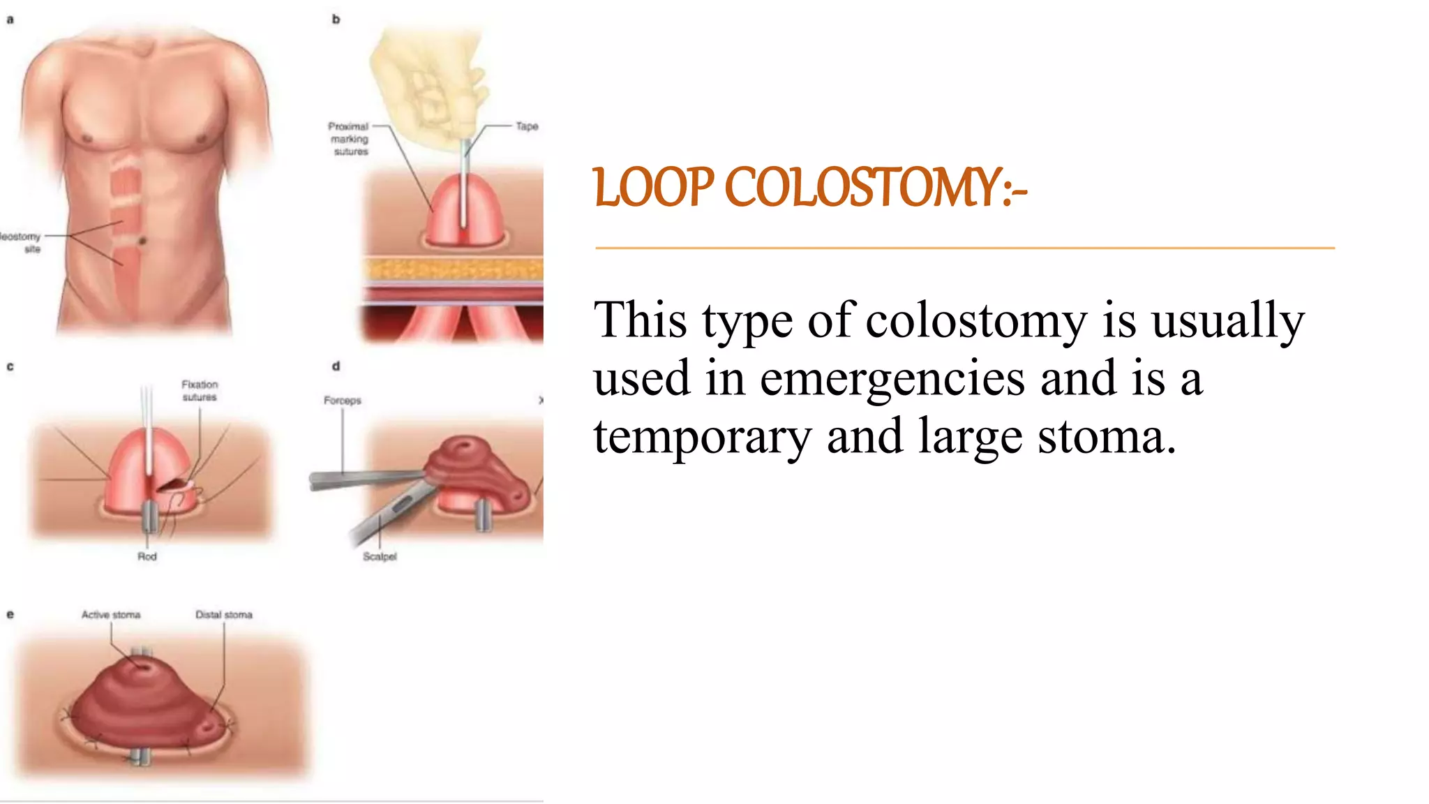 Loop T Colostomy OSTOMY nehu.pptx