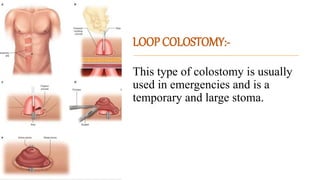 OSTOMY nehu.pptx