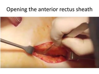 Opening the anterior rectus sheath