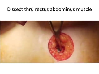 Dissect thru rectus abdominus muscle