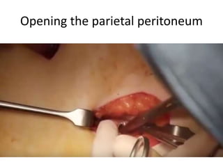 Opening the parietal peritoneum