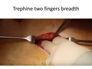 Trephine two fingers breadth