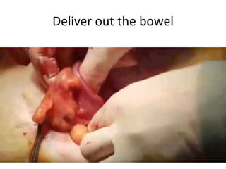 Deliver out the bowel