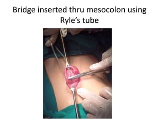 Bridge inserted thru mesocolon using
Ryle’s tube