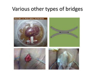Various other types of bridges