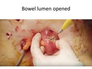 Bowel lumen opened