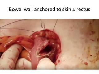 Bowel wall anchored to skin ± rectus