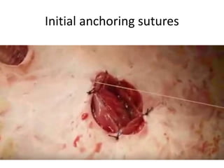 Initial anchoring sutures