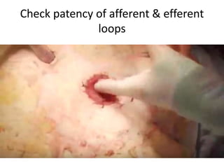 Check patency of afferent & efferent
loops