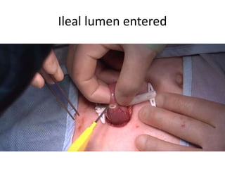 Ileal lumen entered