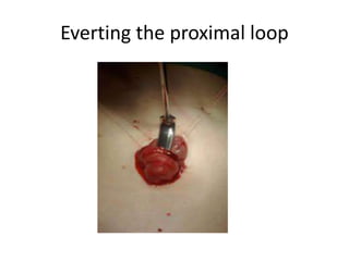 Everting the proximal loop
