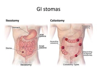 GI stomas
Ileostomy Colostomy