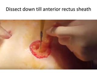 Dissect down till anterior rectus sheath