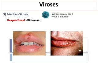 Viroses
9) Principais Viroses        Herpes simplex tipo I
                             Vírus Capsulado
   Hespes Bucal - Sintomas
 