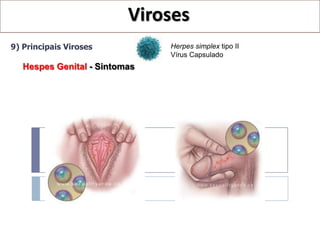 Viroses
9) Principais Viroses          Herpes simplex tipo II
                               Vírus Capsulado
   Hespes Genital - Sintomas
 