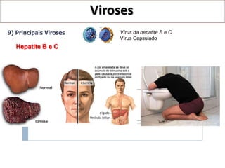 Viroses
9) Principais Viroses       Vírus da hepatite B e C
                            Vírus Capsulado
   Hepatite B e C
 