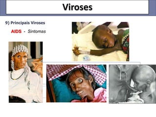 Viroses
9) Principais Viroses

   AIDS - Sintomas
 