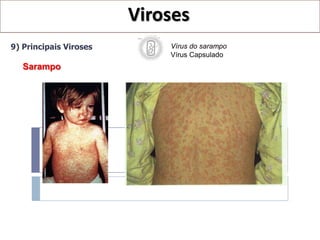 Viroses
9) Principais Viroses       Vírus do sarampo
                            Vírus Capsulado
   Sarampo
 