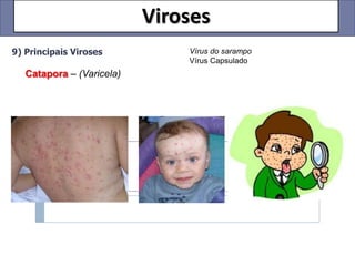 Viroses
9) Principais Viroses          Vírus do sarampo
                               Vírus Capsulado
   Catapora – (Varicela)
 